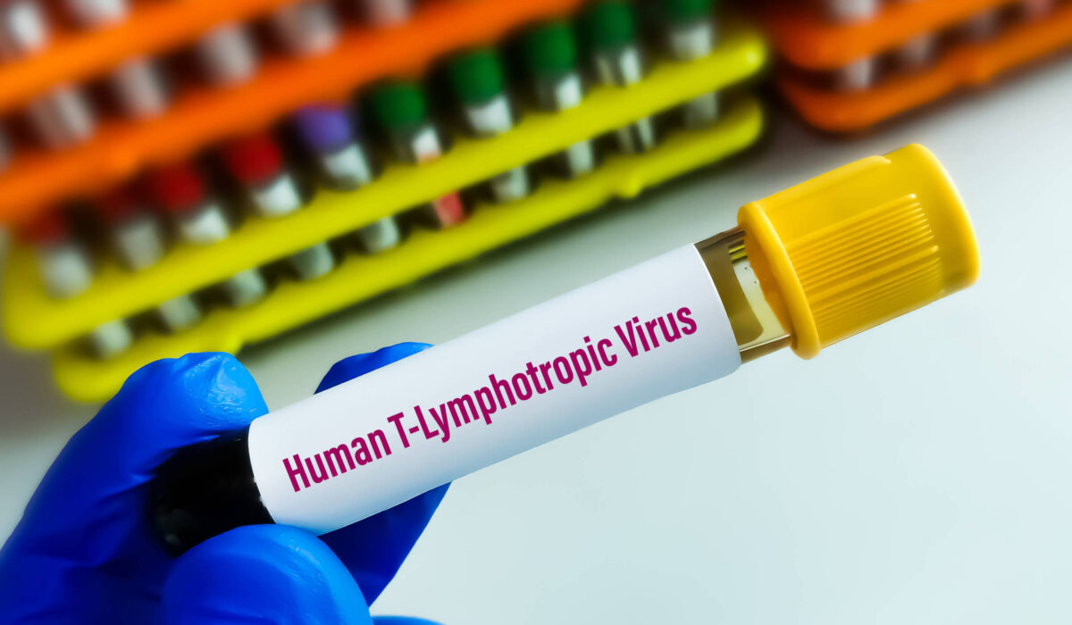 Estudo aponta que vírus HTLV-1 provoca síndrome inflamatória em pacientes assintomáticos