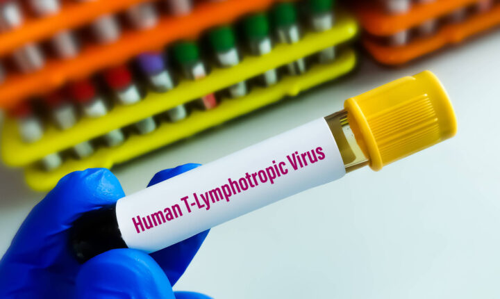 Estudo aponta que vírus HTLV-1 provoca síndrome inflamatória em pacientes assintomáticos