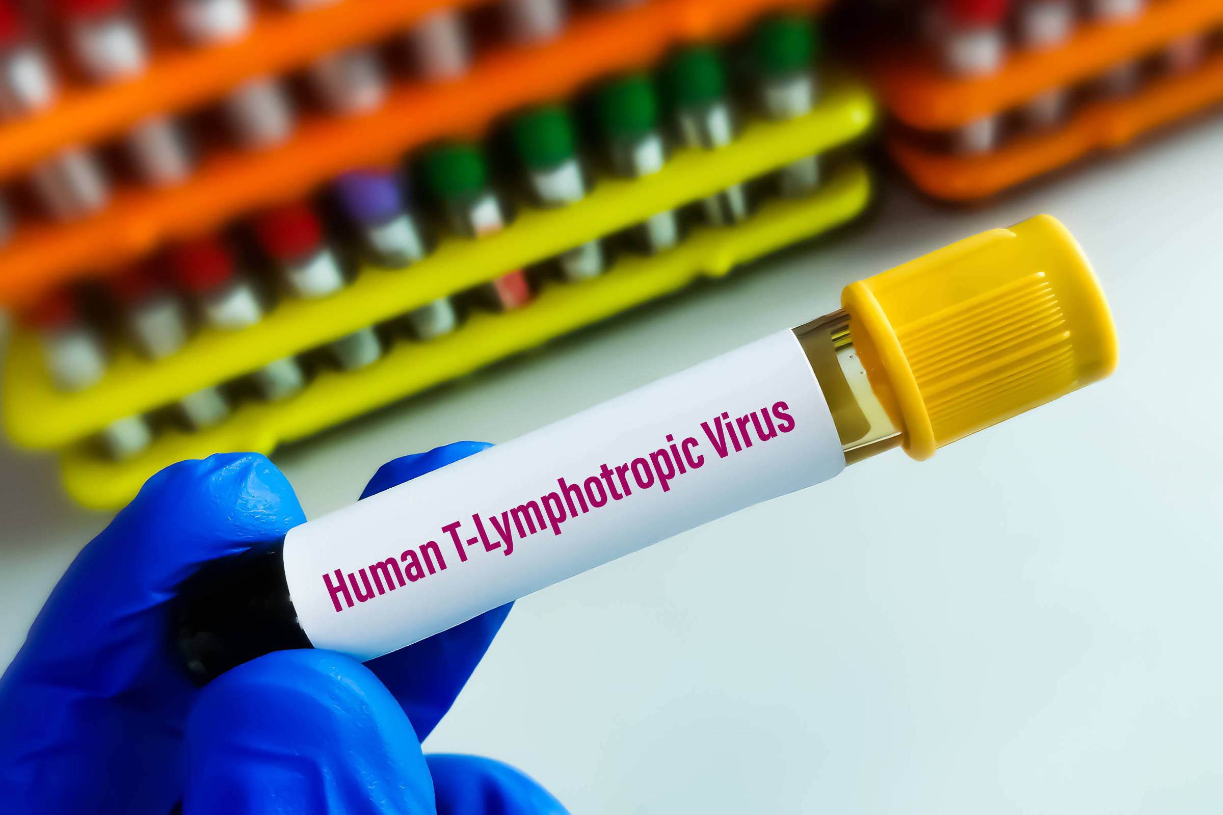 Estudo aponta que vírus HTLV-1 provoca síndrome inflamatória em pacientes assintomáticos