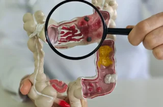 Doenças inflamatórias intestinais quintuplicam no Brasil ao longo de 13 anos
