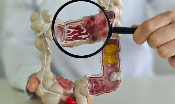 Doenças inflamatórias intestinais quintuplicam no Brasil ao longo de 13 anos