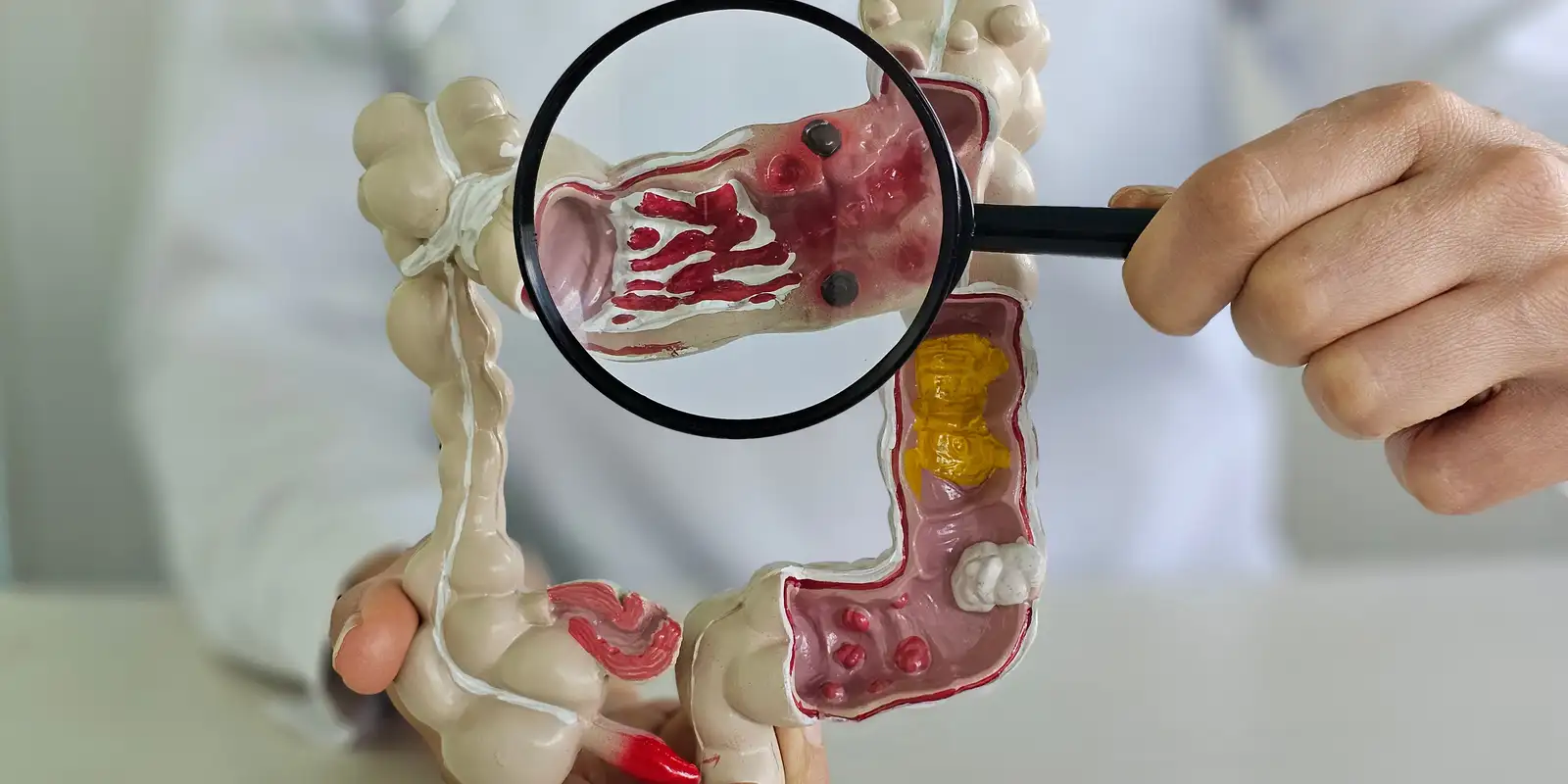 Doenças inflamatórias intestinais quintuplicam no Brasil ao longo de 13 anos