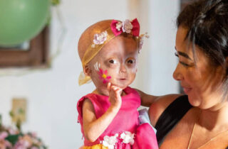 Morre Elis, gêmea com síndrome de envelhecimento precoce; entenda a doença