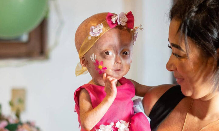 Morre Elis, gêmea com síndrome de envelhecimento precoce; entenda a doença