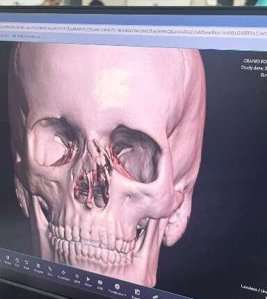 Adolescente de 14 anos espera cirurgia após fraturar nariz no futebol