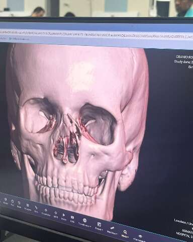 Adolescente de 14 anos espera cirurgia após fraturar nariz no futebol